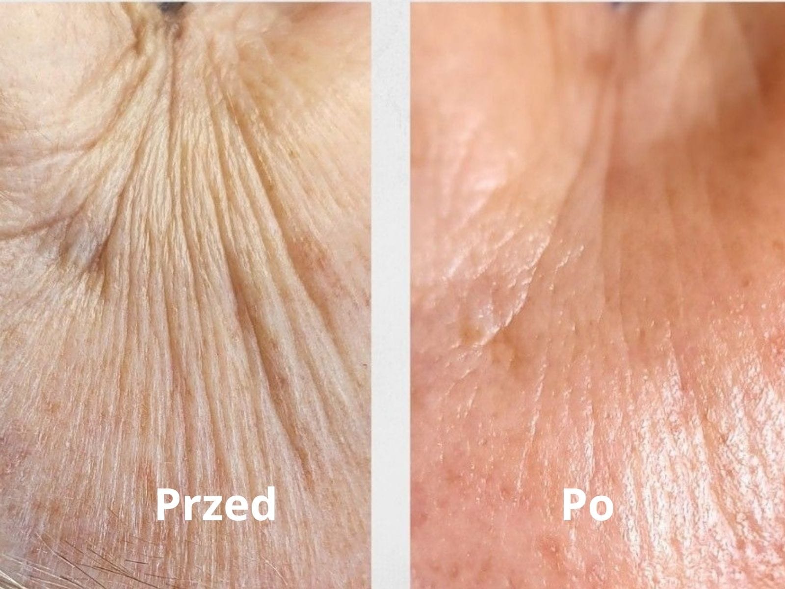 Efekty zabiegów przed i po