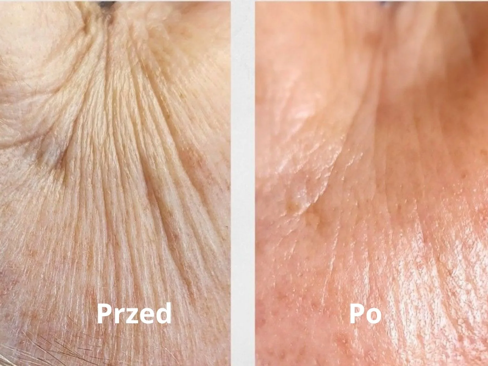 Efekty zabiegów przed i po